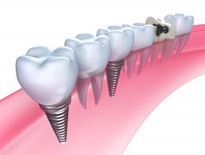 bigstock-Dental-implants-in-the-gum-I-30539468-300x227